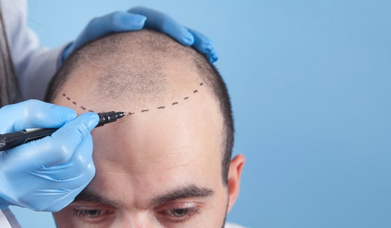 ¿Cómo debe ser el pelo para hacer una micropigmentación?